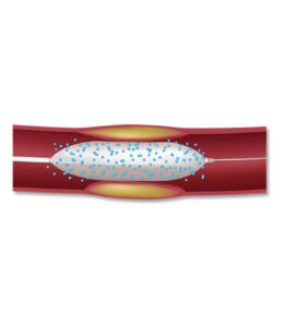 Coronary Drug Eluting Balloon