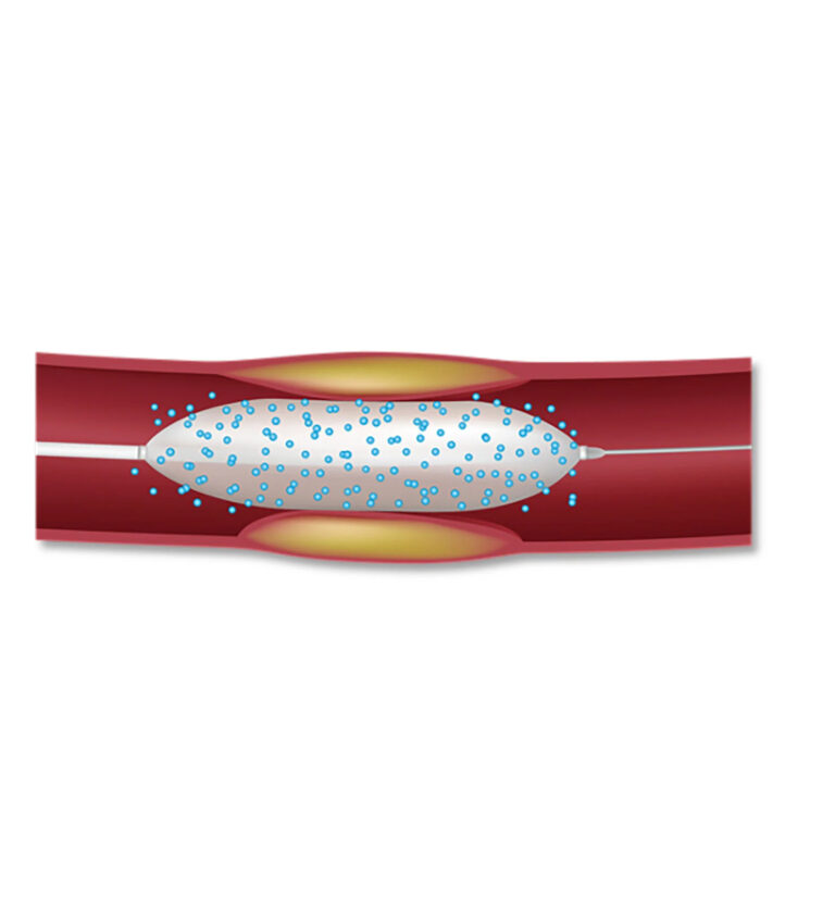 Coronary Drug Eluting Balloon