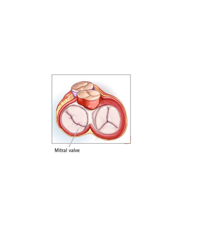 Mitral Valves